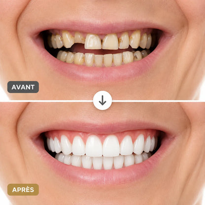 SmileForm | Prothese Dentaire Amovible Complète – Dentier en Silicone Haut et Bas