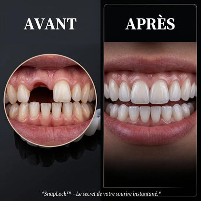 SmileCover | Facettes Dentaires Amovibles Cosmétique Snap-On