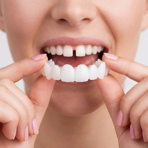 SmileCover | Facettes Dentaires Amovibles Cosmétique Snap-On