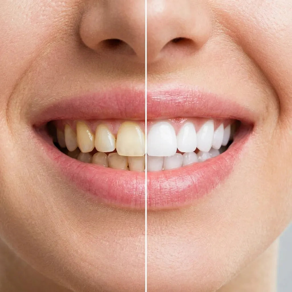 SmilePerfect | Prothèse Dentaire Cosmétique Amovible Aspect Naturel