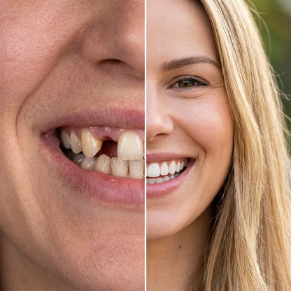 SmilePerfect | Prothèse Dentaire Cosmétique Amovible Aspect Naturel